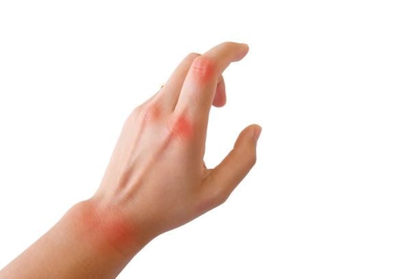 hand with red spot on fingers and wrists. Arthritis pain concept.