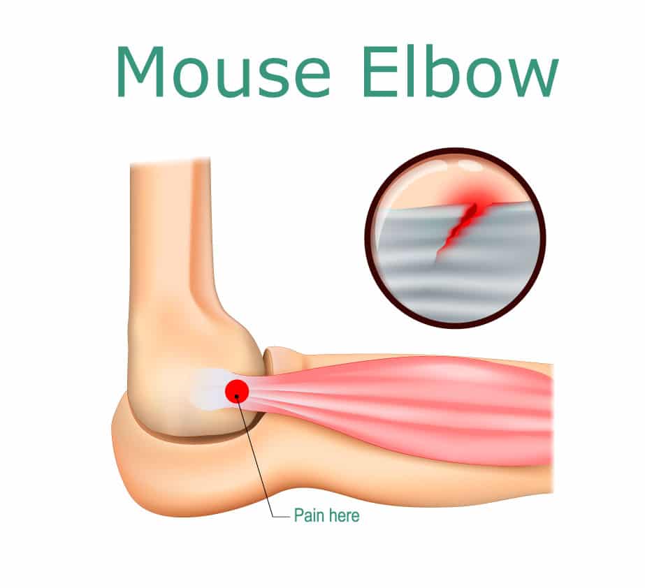 Mouse-elbow-cbd